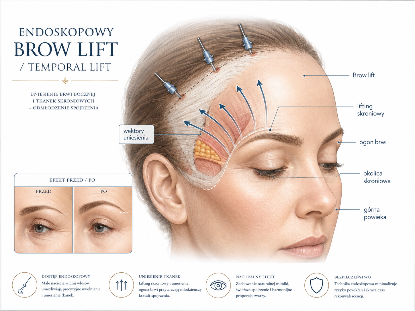 Profesjonalna ilustracja brow lift i liftingu skroniowego