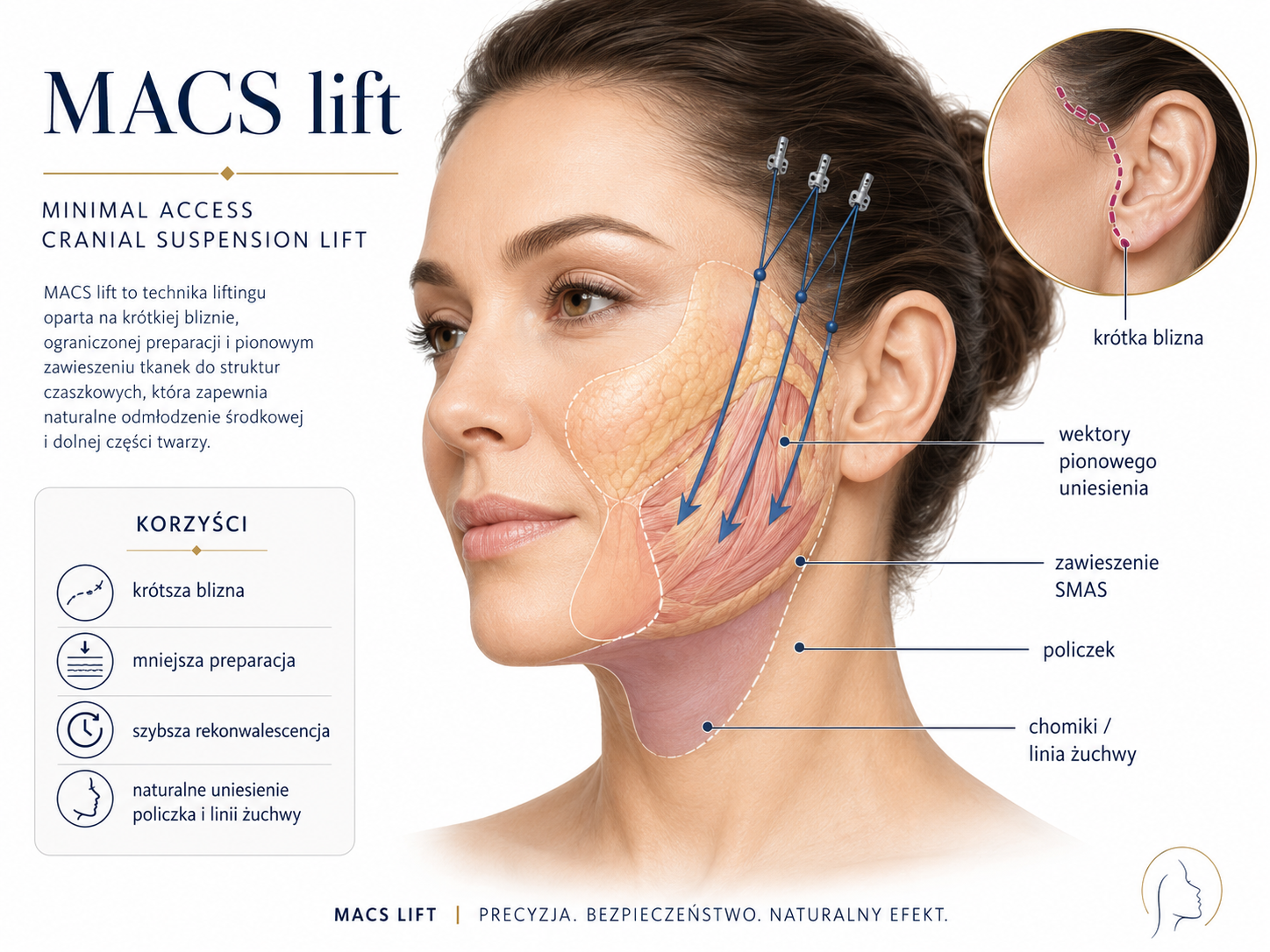 Ilustracja medyczna techniki MACS lift